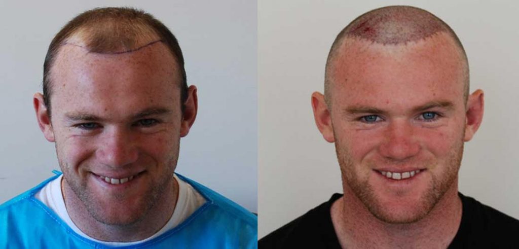 Hair Transplant